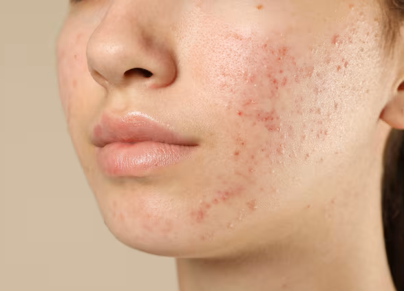 Natural Treatments for Skin Acne and Blemishes